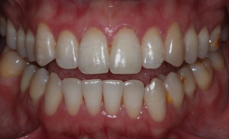 Close up of mouth after repairing broken tooth