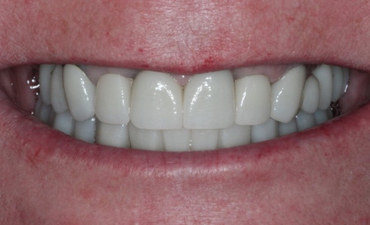 Close up of mouth after repairing broken tooth