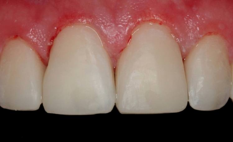 Close up of upper teeth after orthodontic treatment