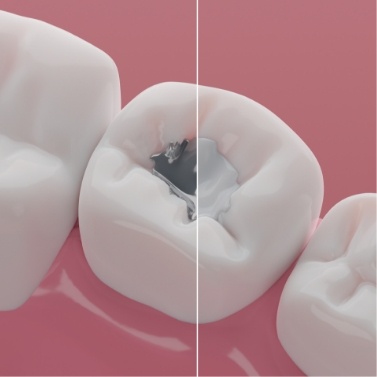 Illustrated tooth before and after removing amalgam filling