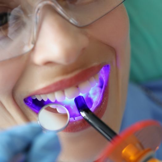 Close up of woman receiving dental sealants on her teeth