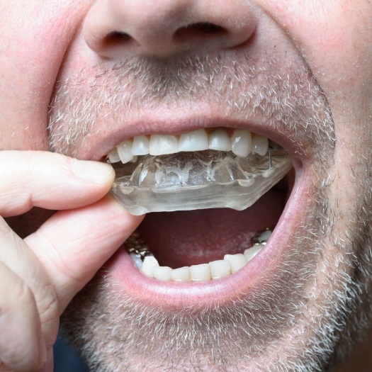 Close up of man placing nightguard into his mouth