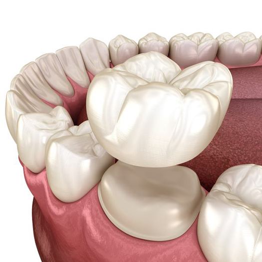 Illustration of dental crown being placed on tooth