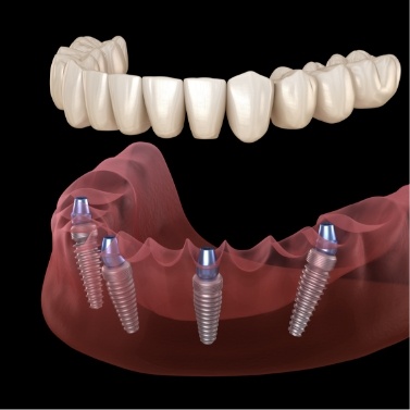 Illustrated denture being placed onto four dental implants