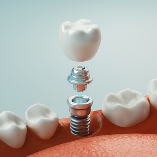Illustrated dental implant with dental crown being placed into the gums