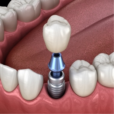 Illustrated dental crown being placed onto a dental implant