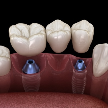 Illustrated dental bridge being placed onto two dental implants