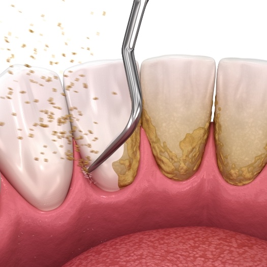 Illustrated dental instrument removing plaque buildup from teeth