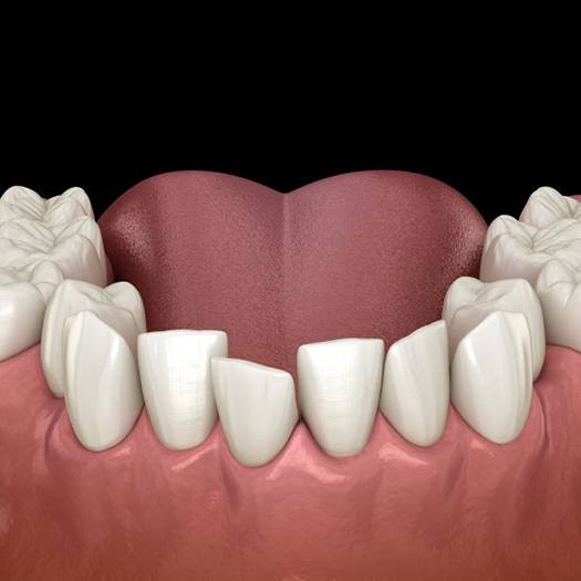 Illustration of crowded, crooked teeth in lower dental arch