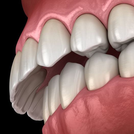Illustration of an overbite against dark background
