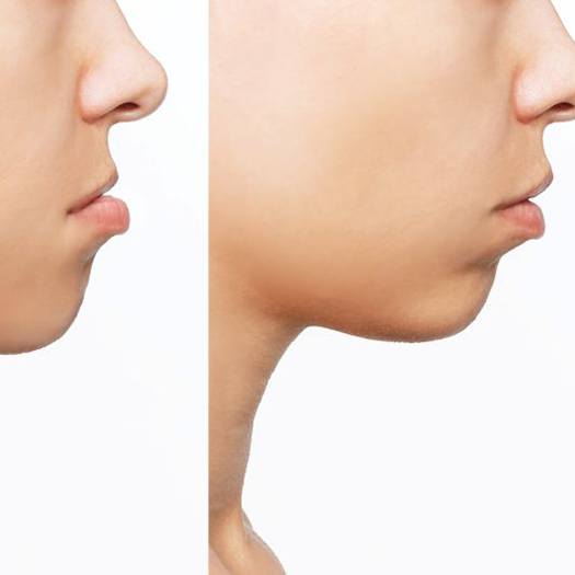 Person’s profile before and after treatment for underbite