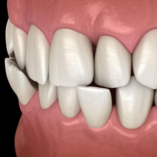 Illustration of a crossbite against dark background