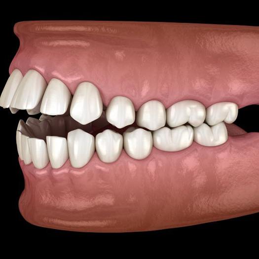 Illustration of an open bite viewed from the side