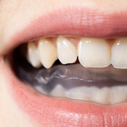 Close up of person with dental tray over their teeth