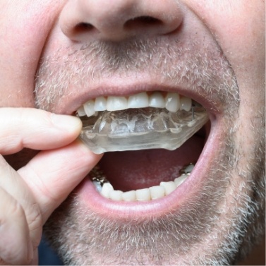 Man placing a nightguard in his mouth