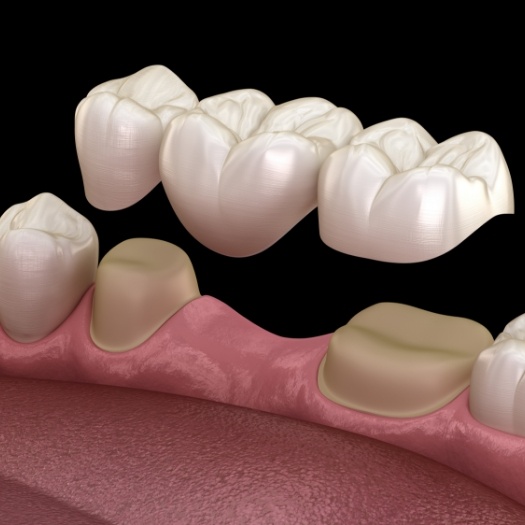 Illustrated dental bridge being placed to replace a missing tooth