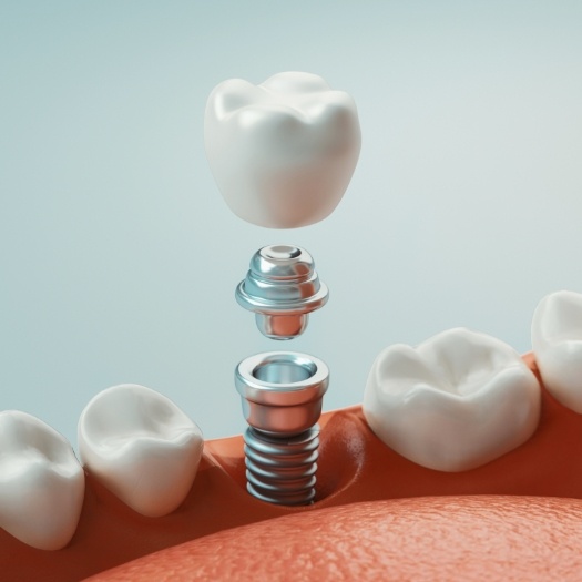 Illustrated dental implant and dental crown replacing a missing tooth