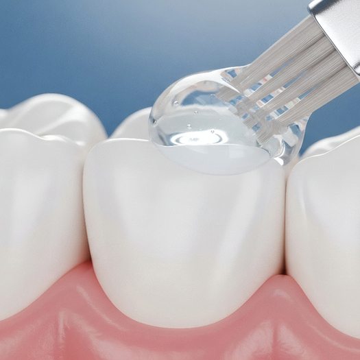 Illustration of sealant being placed on a tooth