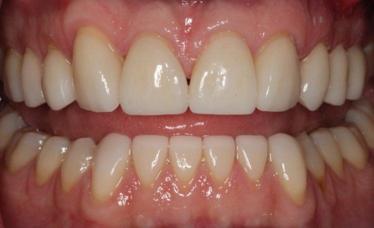 Close up of mouth after gum recontouring