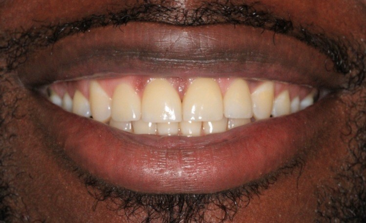 Man after gummy smile correction