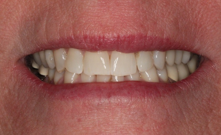 Close up of mouth with full row of upper teeth