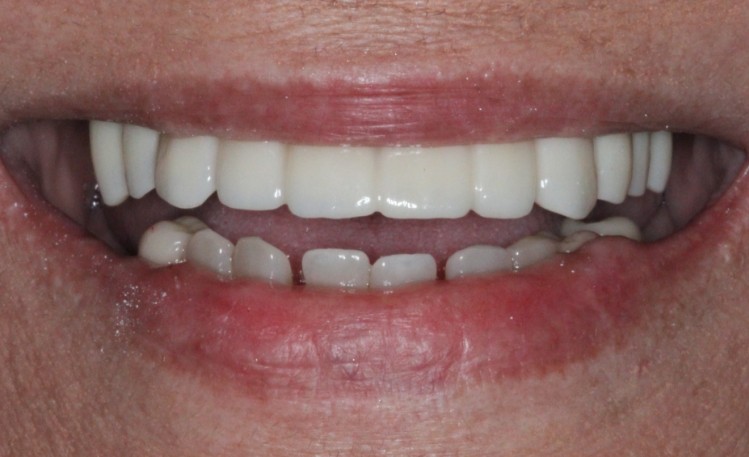 Close up of mouth after repairing broken tooth