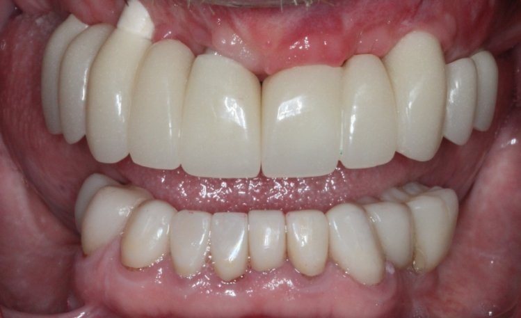 Close up of mouth after repairing broken tooth