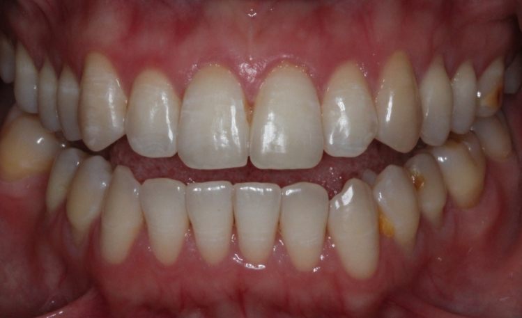 Close up of mouth after repairing broken tooth