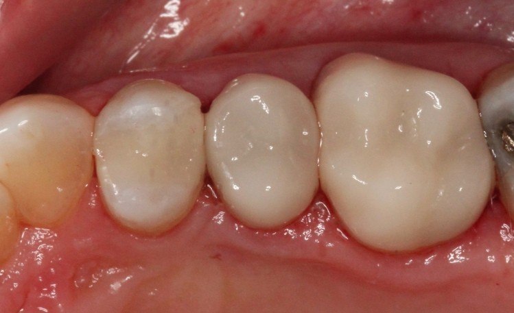 Close up of teeth with tooth colored fillings