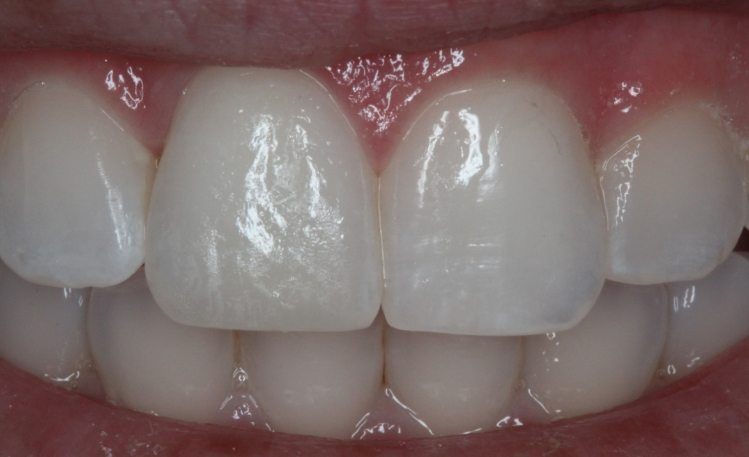 Close up of two front teeth with no chips