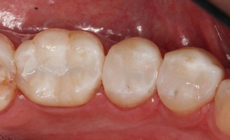 Row of teeth with tooth colored fillings