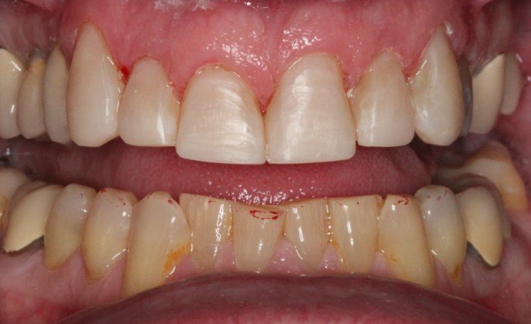 Close up of mouth after gum treatment