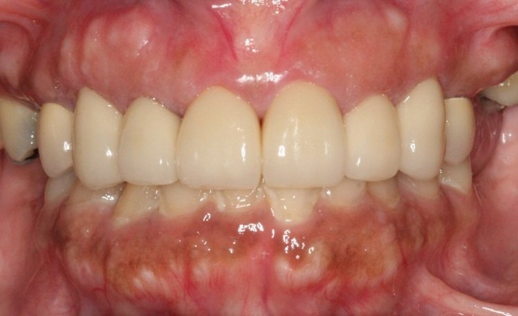 Mouth after gum recontouring