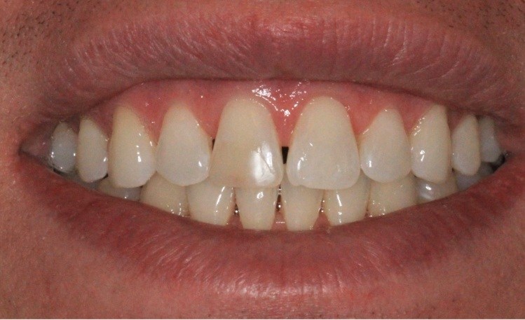 Person with small gaps between some teeth