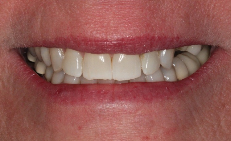 Close up of mouth with a missing upper tooth