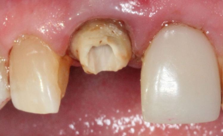 Close up of mouth with severely broken tooth