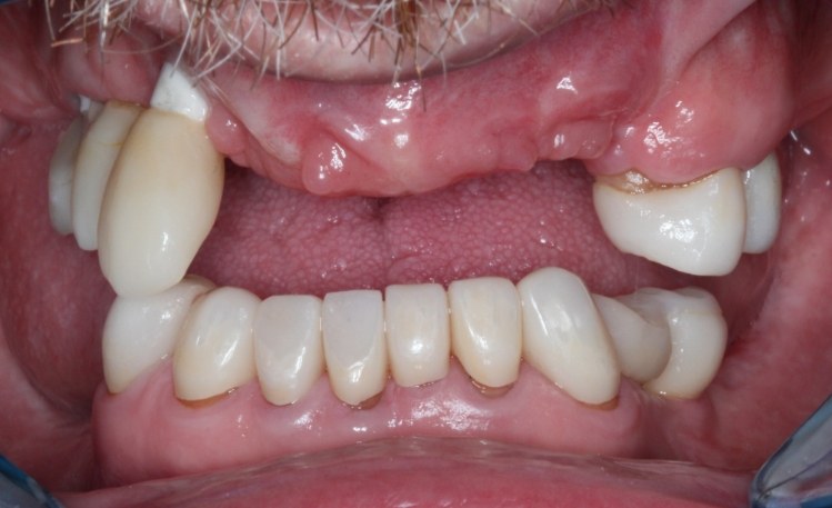 Close up of mouth with severely broken tooth