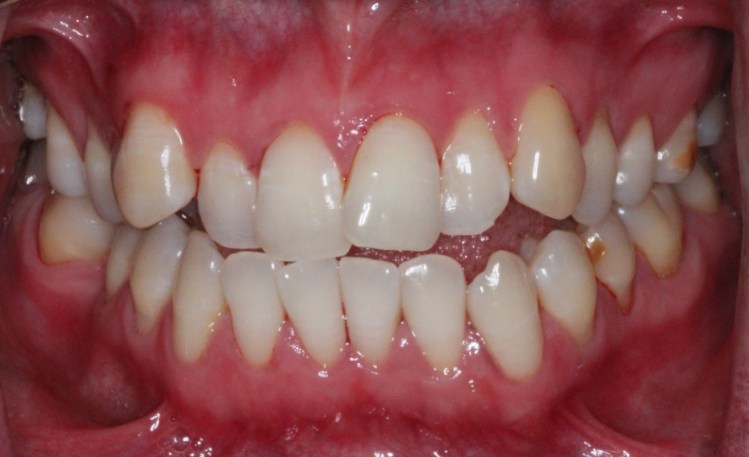 Close up of mouth with severely broken tooth