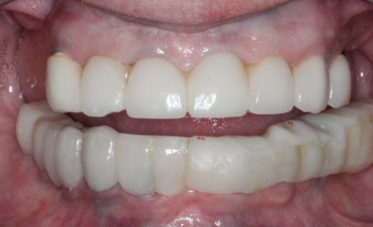 Close up of mouth with severely broken tooth