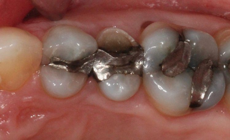 Close up of teeth with metal fillings