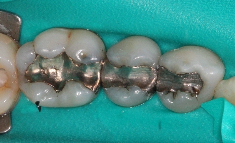 Row of teeth with metal fillings
