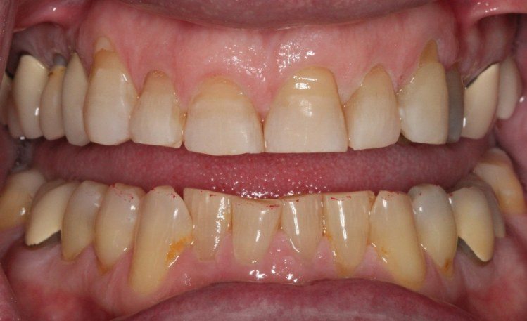 Close up of mouth before gum treatment