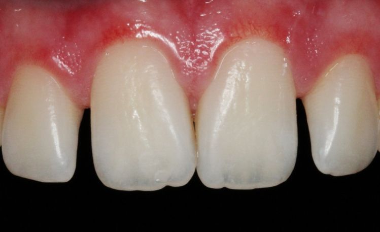 Close up of misaligned upper teeth