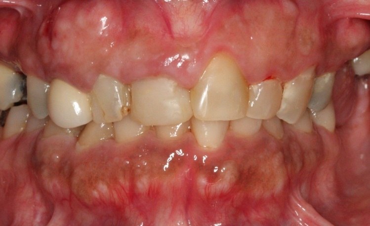 Mouth with uneven gumline