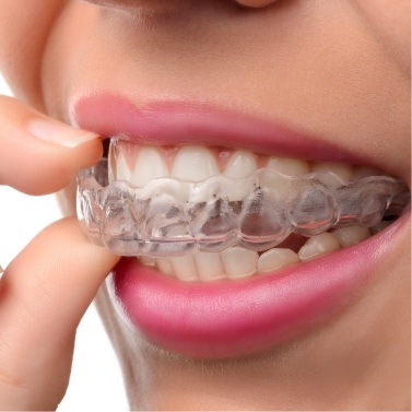 Close up of person placing Invisalign aligner in their mouth