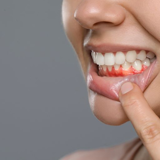 Close-up of woman’s mouth with red, swollen gums