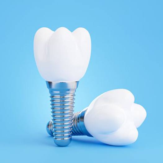 Illustration of two zirconia implants in lower dental arch