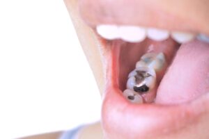 Old amalgam fillings in woman’s mouth 