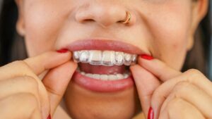 Close-up of person’s teeth with Invisalign aligner
